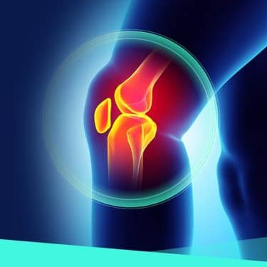 Čo je to artróza? neliečiteľná choroba kĺbov a ako im pomôcť