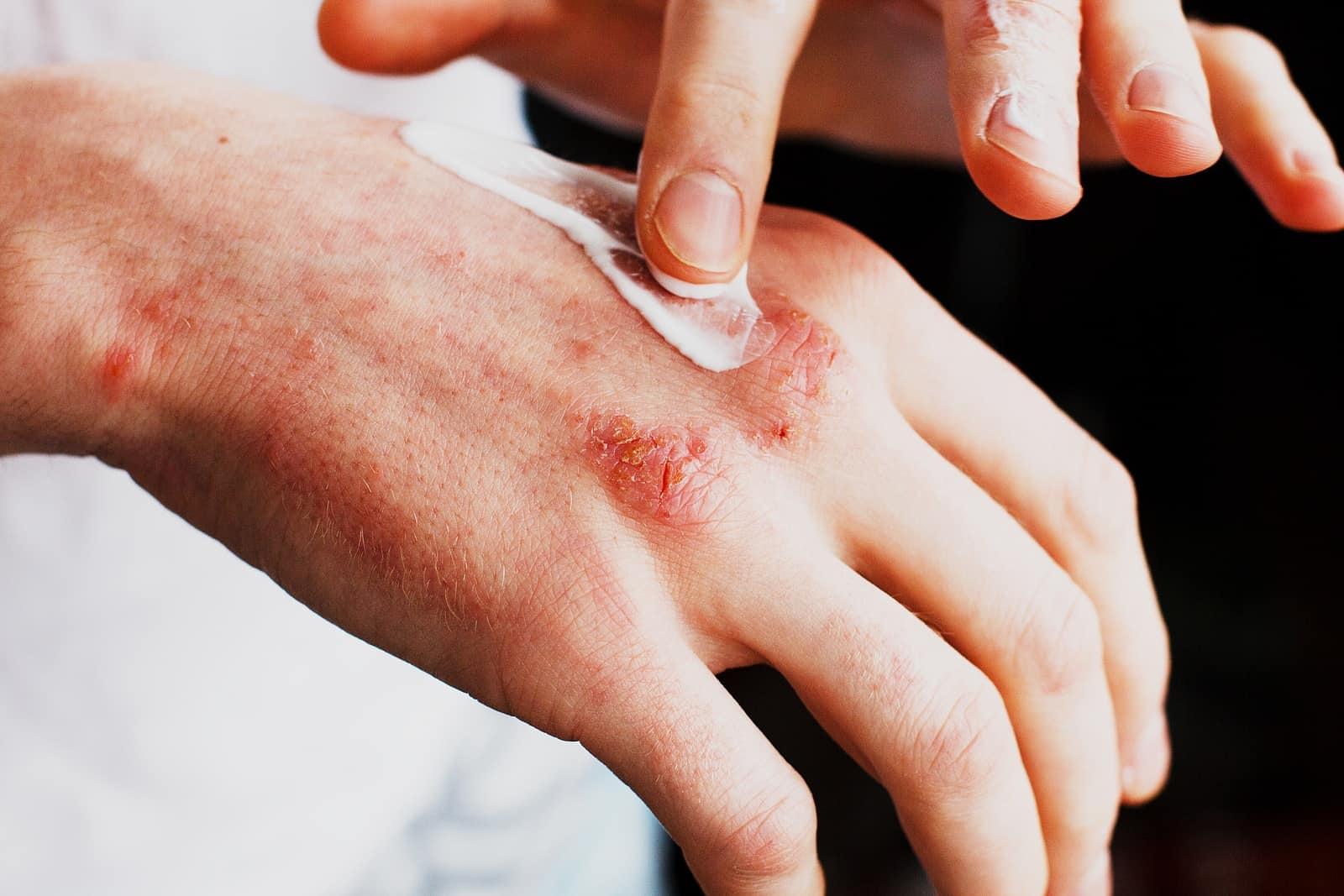 Pikkelysömör vagy seborrhoeás dermatitisz? Másképp kell kezelni